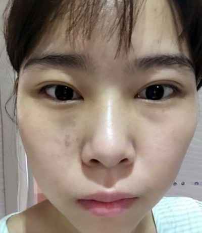 超 声 波去眼袋做最年轻得自己 超 声 波去眼袋做最年轻得自己