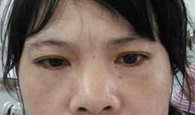 超 声 波去眼袋做最年轻得自己 超 声 波去眼袋做最年轻得自己