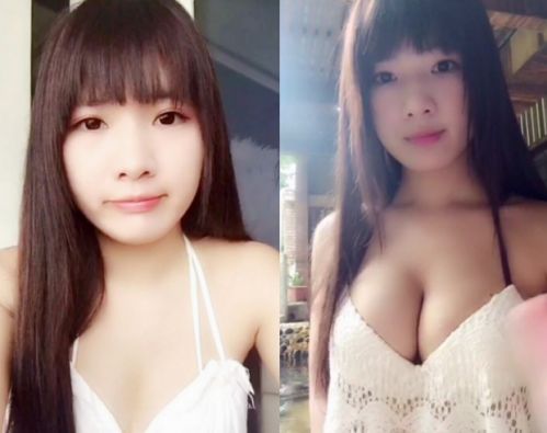 自体脂肪丰胸填充多了可以自行代谢掉吗?947 自体脂肪丰胸填充多了可以自行代谢掉吗?947