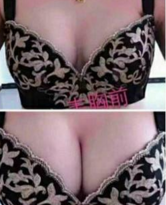 自体脂肪丰胸填充多了可以自行代谢掉吗?947 自体脂肪丰胸填充多了可以自行代谢掉吗?947