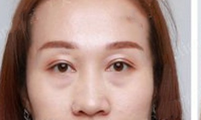 去眼袋要趁早,不手术去眼袋还真办不到987 去眼袋要趁早,不手术去眼袋还真办不到987