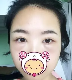 去眼袋要趁早,不手术去眼袋还真办不到987 去眼袋要趁早,不手术去眼袋还真办不到987