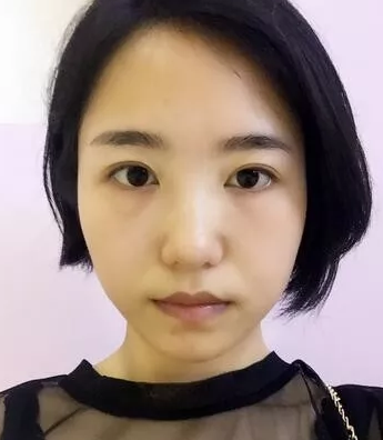 去眼袋要趁早,不手术去眼袋还真办不到987 去眼袋要趁早,不手术去眼袋还真办不到987