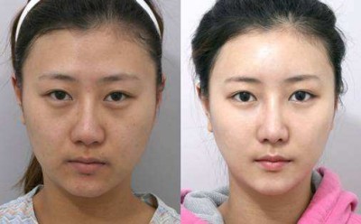 超 声 波去眼袋,不做黄脸婆 超 声 波去眼袋,不做黄脸婆