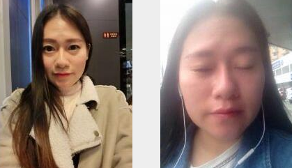 超声波去眼袋会出现淤青现象吗?404 超声波去眼袋会出现淤青现象吗?404