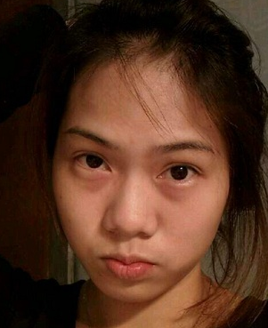 超声波去眼袋会出现淤青现象吗?404 超声波去眼袋会出现淤青现象吗?404