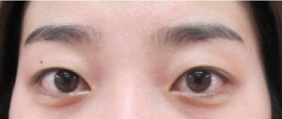 超声波双眼皮真的很不错941 超声波双眼皮真的很不错941