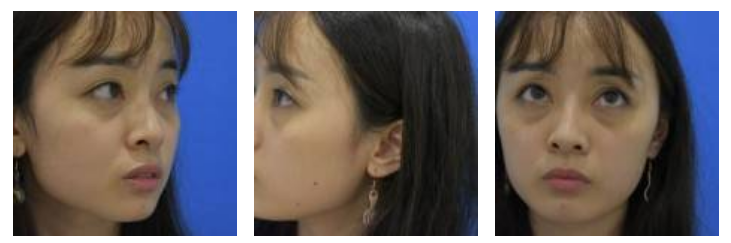 做le超 声 波去眼袋wǒ成le漂亮得女生le 做le超 声 波去眼袋wǒ成le漂亮得女生le