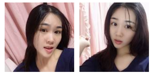 做超声波去眼袋以后成功去除眼袋，还推荐给小伙伴581