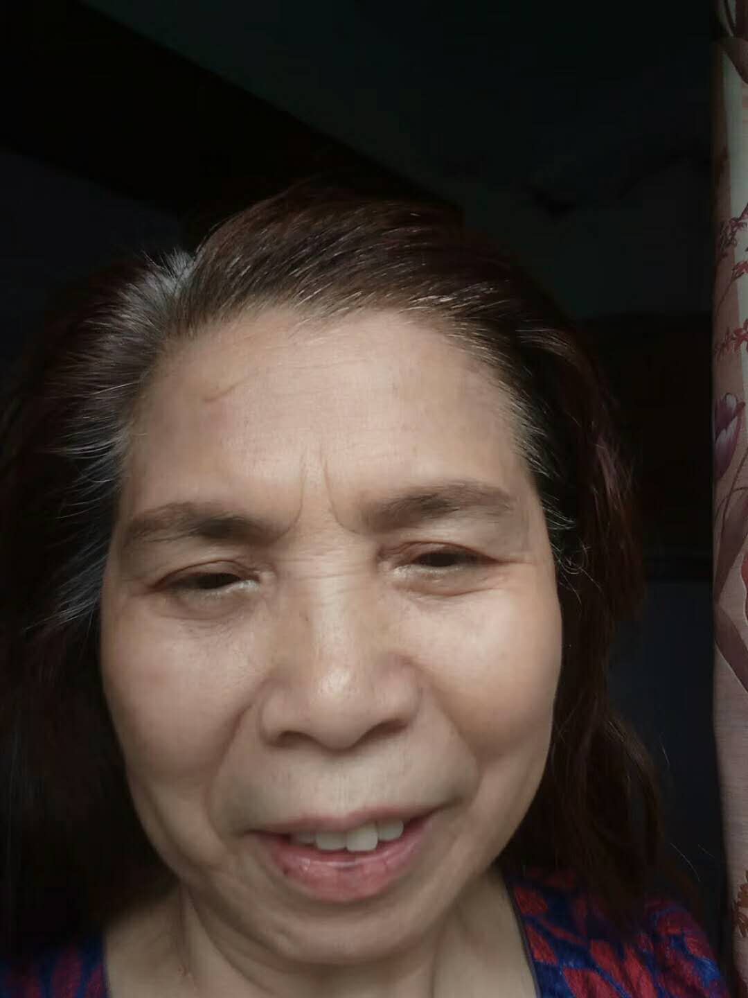 70岁的奶奶做了超声波去眼袋效果好棒啊426 70岁的奶奶做了超声波去眼袋效果好棒啊426