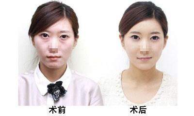 超声波去眼袋后水肿的正确护理方式你get到了吗？493