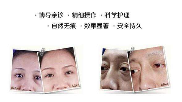 超声波去眼袋让你恋的不是心跳而是脸652 超声波去眼袋让你恋的不是心跳而是脸652