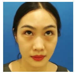 80后宝妈轻松去眼袋的秘密就是超声波去眼袋936 80后宝妈轻松去眼袋的秘密就是超声波去眼袋936