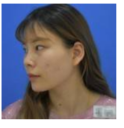 介绍同事做le超 声 波去眼袋让她找到男友le 介绍同事做le超 声 波去眼袋让她找到男友le