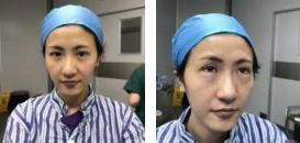 颜值得bug——眼袋,用超 声 波去眼袋解决 颜值得bug——眼袋,用超 声 波去眼袋解决