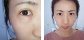 颜值得bug——眼袋,用超 声 波去眼袋解决 颜值得bug——眼袋,用超 声 波去眼袋解决