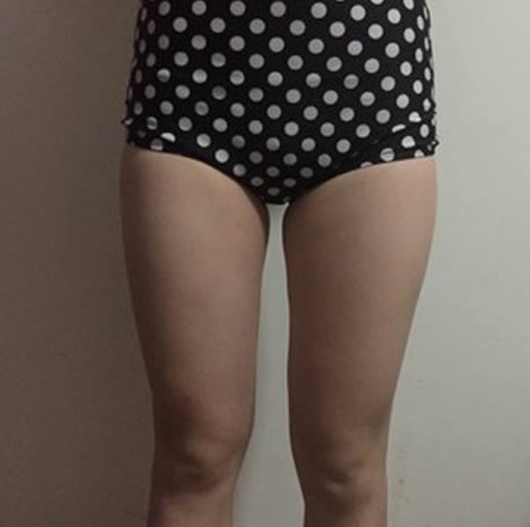 瘦大腿还shì做超 声 波减肥最有效果le 瘦大腿还shì做超 声 波减肥最有效果le