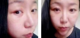 超 声 波去眼袋——“袋”走更“睛”彩 超 声 波去眼袋——“袋”走更“睛”彩