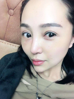 超声波双眼皮在眼睛宽窄这方面的设计有何保障呢？736