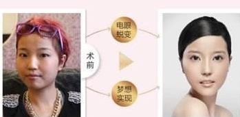 超声波双眼皮在眼睛宽窄这方面的设计有何保障呢？736
