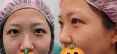 超声波双眼皮让我再也不当小眼妹子644 超声波双眼皮让我再也不当小眼妹子644