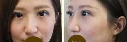 超声波双眼皮让我再也不当小眼妹子644 超声波双眼皮让我再也不当小眼妹子644
