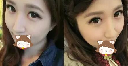 超声波双眼皮让我再也不当小眼妹子644 超声波双眼皮让我再也不当小眼妹子644