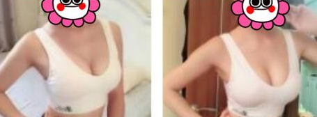 之前在重庆超雅做双眼皮，现在做超声波自体脂肪丰胸284
