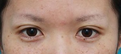 超声波双眼皮,让你阳光自信376 超声波双眼皮,让你阳光自信376