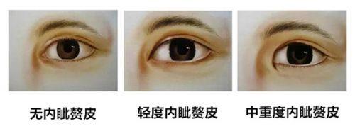 听说你也想getwǒ同款超 声 波双眼 皮效果? 听说你也想getwǒ同款超 声 波双眼 皮效果?