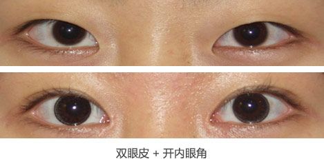 听说你也想getwǒ同款超 声 波双眼 皮效果? 听说你也想getwǒ同款超 声 波双眼 皮效果?