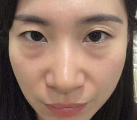 玩手机长了眼袋，我做了超声波祛眼袋成功祛除眼袋232