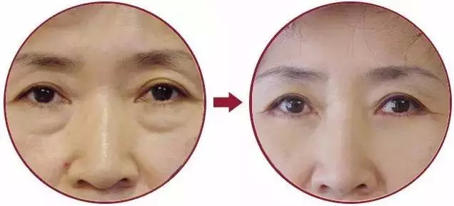 相亲失败因为眼袋?超 声 波去眼袋解决!! 相亲失败因为眼袋?超 声 波去眼袋解决!!