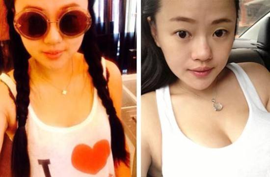 超声波自体脂肪丰胸手术后再也不用塑形内衣了！261