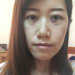 舒服了,超声波去眼袋812 舒服了,超声波去眼袋812