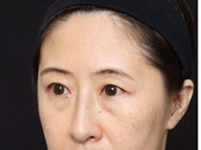 超声波去眼袋,让自己的双眼重现明亮有神214 超声波去眼袋,让自己的双眼重现明亮有神214