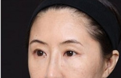 超声波去眼袋,让自己的双眼重现明亮有神214 超声波去眼袋,让自己的双眼重现明亮有神214