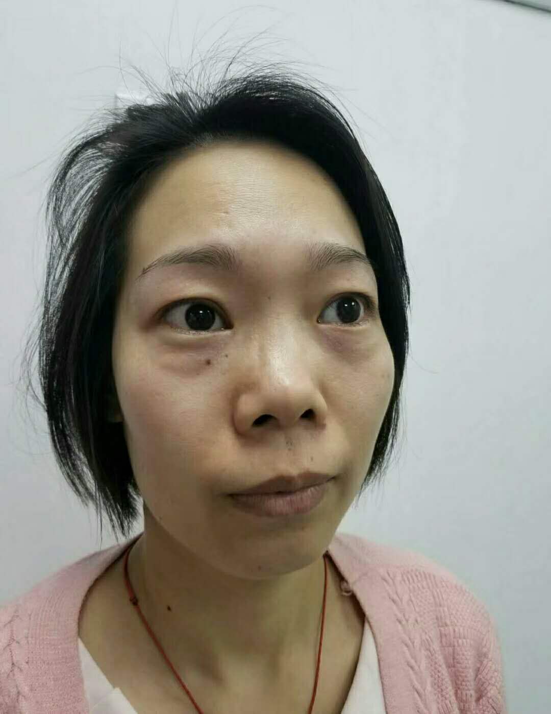 我做超声波去眼袋把我多年劳苦的眼袋给祛除了144 我做超声波去眼袋把我多年劳苦的眼袋给祛除了144