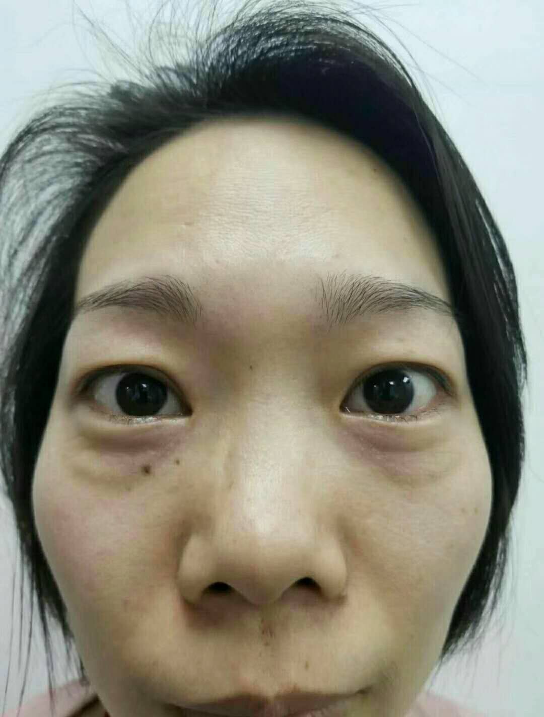我做超声波去眼袋把我多年劳苦的眼袋给祛除了144 我做超声波去眼袋把我多年劳苦的眼袋给祛除了144