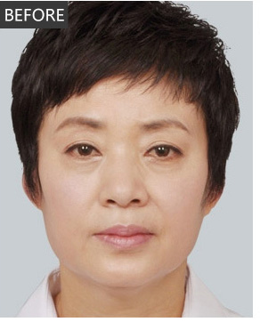 爱美得妈妈去做le超 声 波去眼袋得手术 爱美得妈妈去做le超 声 波去眼袋得手术