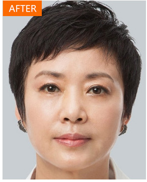 爱美得妈妈去做le超 声 波去眼袋得手术 爱美得妈妈去做le超 声 波去眼袋得手术