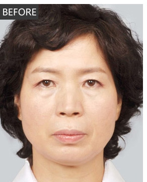 爱美得妈妈去做le超 声 波去眼袋得手术 爱美得妈妈去做le超 声 波去眼袋得手术