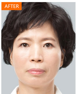爱美得妈妈去做le超 声 波去眼袋得手术 爱美得妈妈去做le超 声 波去眼袋得手术
