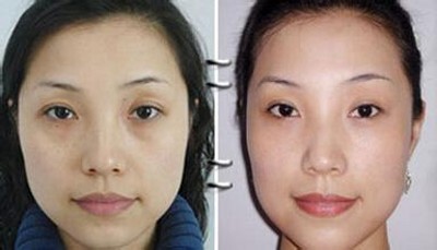 超声波去眼袋,和没有眼袋前一样的漂亮397 超声波去眼袋,和没有眼袋前一样的漂亮397