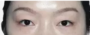 小琳成功得做le超 声 波双眼 皮拥有le迷人双眼