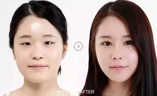 小琳成功得做le超 声 波双眼 皮拥有le迷人双眼