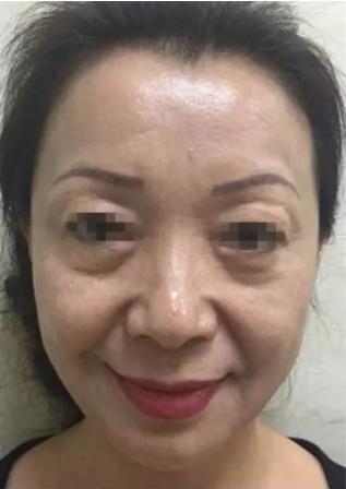 肌肤问题也可以做超级微拉美来恢复881 肌肤问题也可以做超级微拉美来恢复881