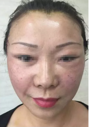 肌肤问题也可以做超级微拉美来恢复881 肌肤问题也可以做超级微拉美来恢复881
