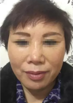 肌肤问题也可以做超级微拉美来恢复881 肌肤问题也可以做超级微拉美来恢复881