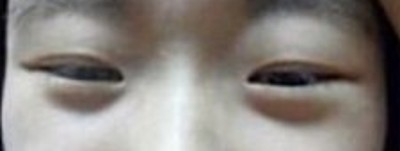 超声波双眼皮,真的是很自然呢954 超声波双眼皮,真的是很自然呢954